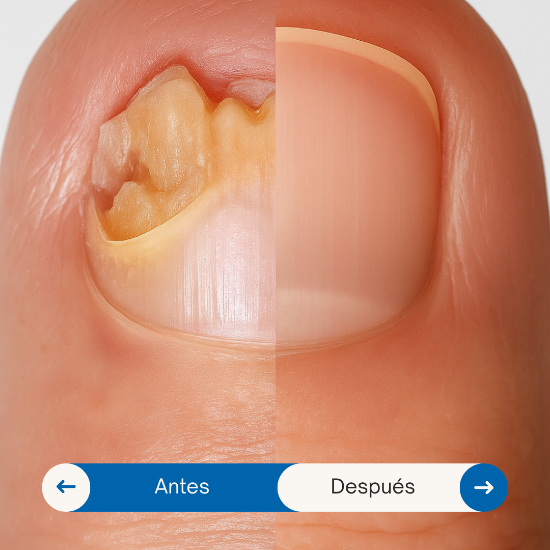 UÑAS SIN VERGÜENZA Tratamiento AntiHongo 2x1